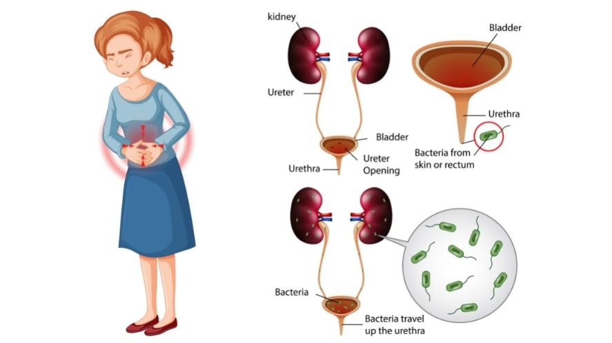 Tips To Prevent Urinary Tract Infection Causes And Symptoms Medintu