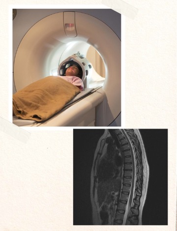 MRI scan for Thoracolumbar