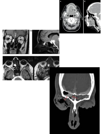 cisternography CT scan