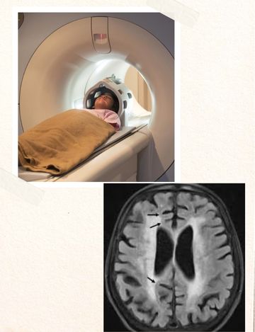mri scan for brain dimentia