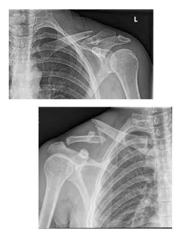 CT scan for clavicle in hyderabad