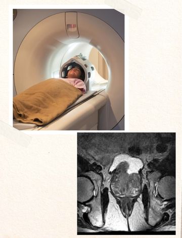 mri prostate