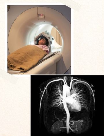 Mri scan for angiogram