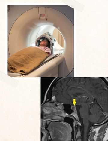 MRI Scan for Sella