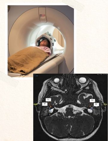 Mri scan for cochlea