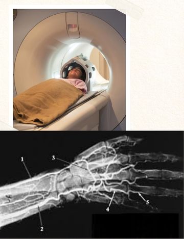 upper limb angiography