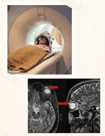 mri scan for eye