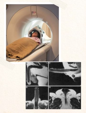 MRI Scan for Penis