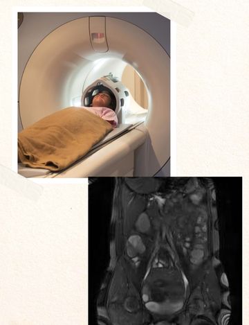 MRI Scan for Enterography