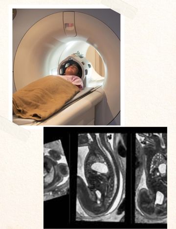 mri scan for fetus