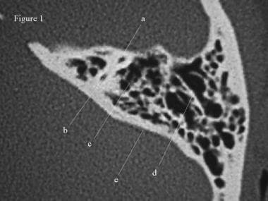 ct scan temporal bone