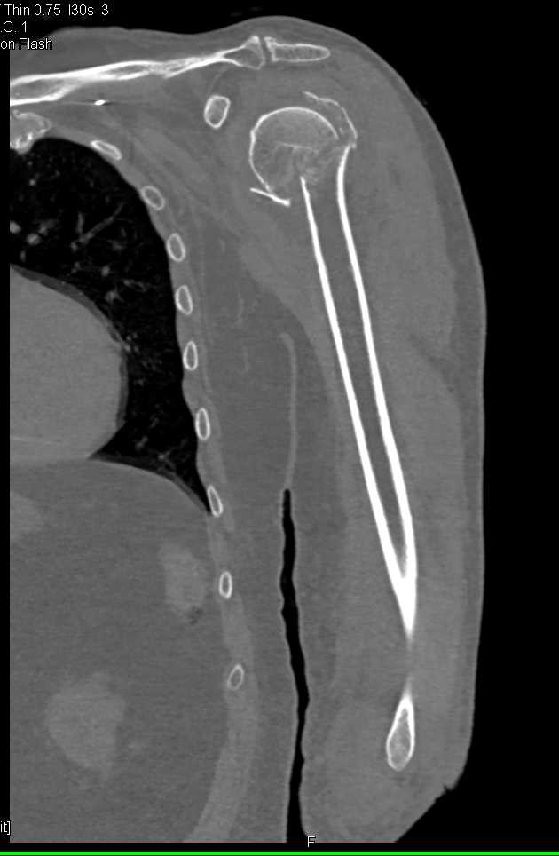 Ct Scan Humerus