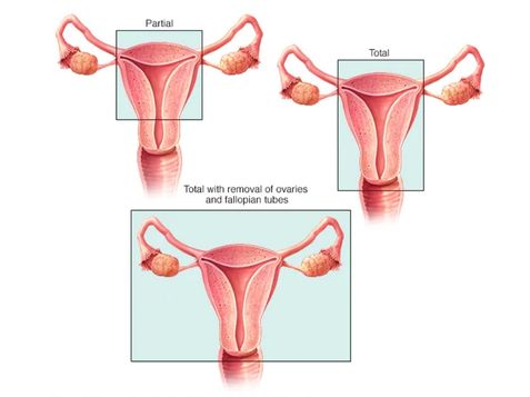 Types of Hysterectomy