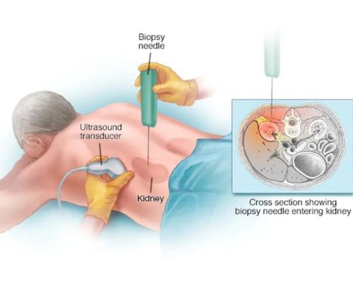 Kidney Stone Removal Preparation
