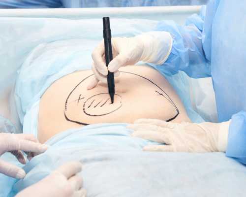 liposuction surgery