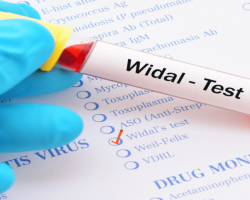 Widal Test Price in Bangalore