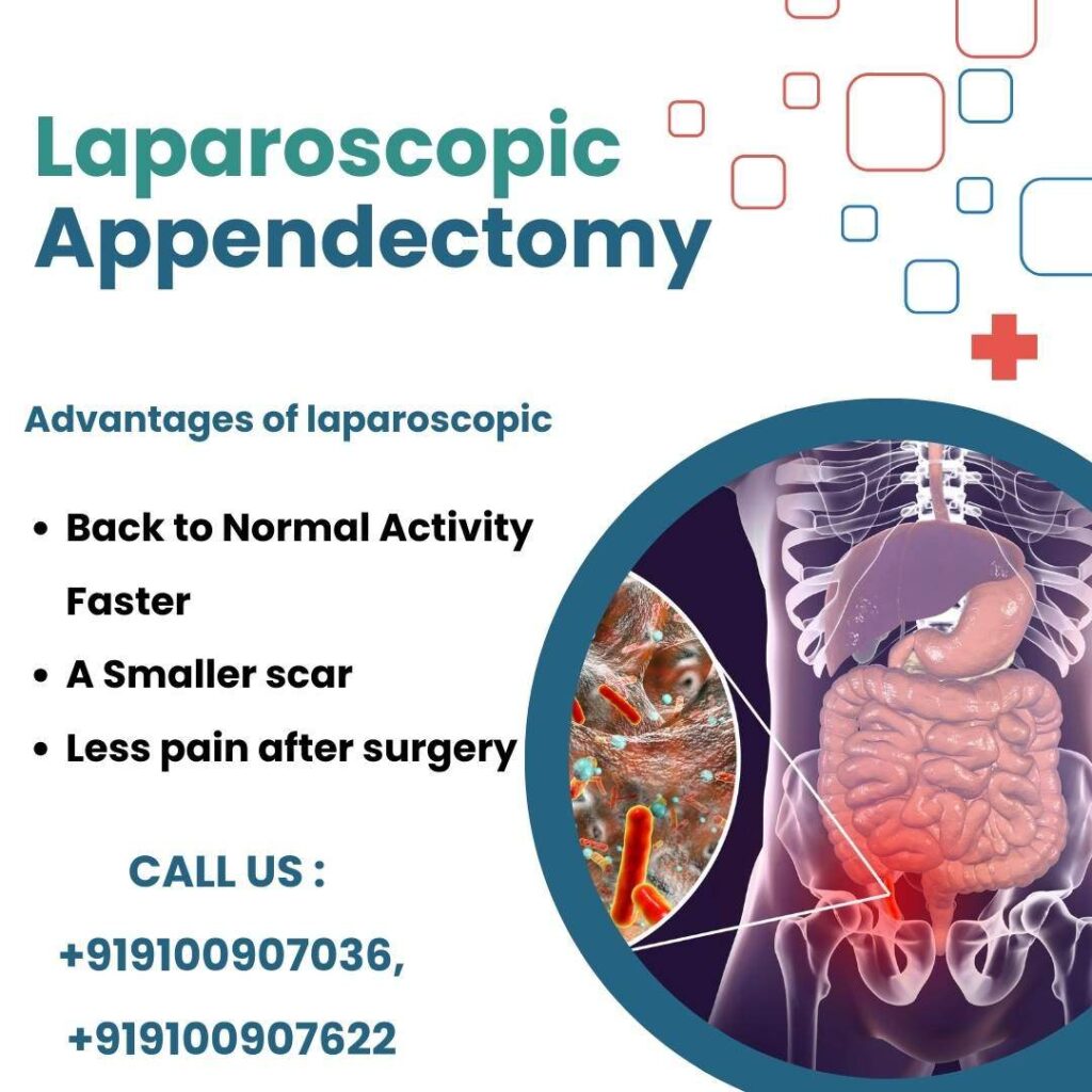 Laparoscopic Appendectomy- Appendix Removal Surgery