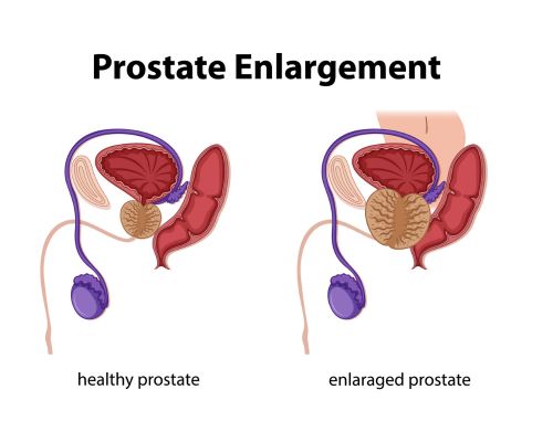 Prostate Enlargement
