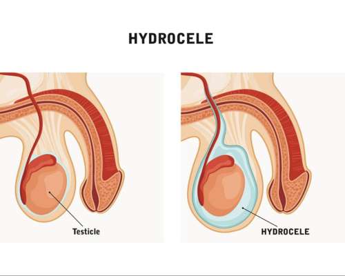 Hydrocele