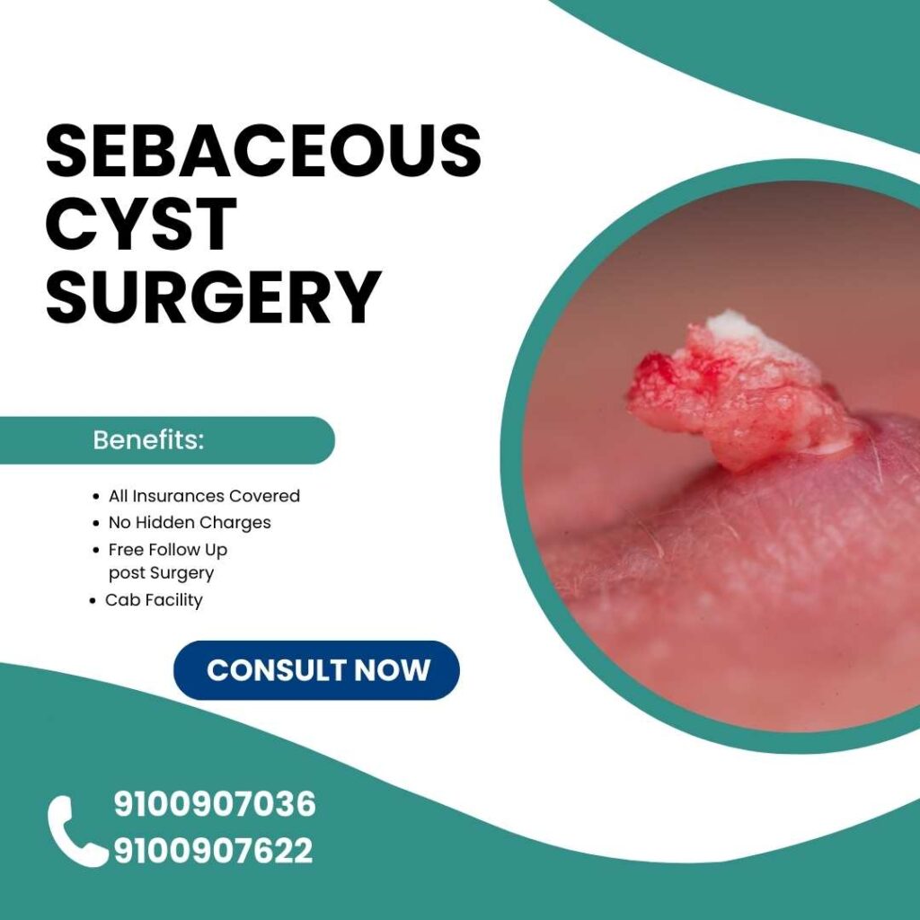 Sebaceous Cyst Surgery