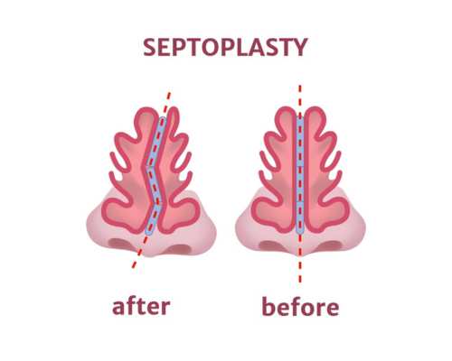 Septoplasty