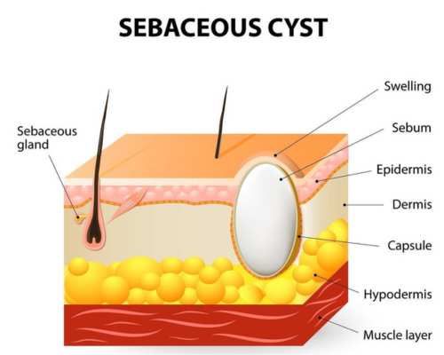 Sebaceous cyst