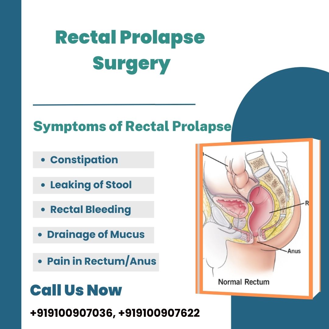 Rectal Prolapse | Symptoms, causes & treatment | Medintu