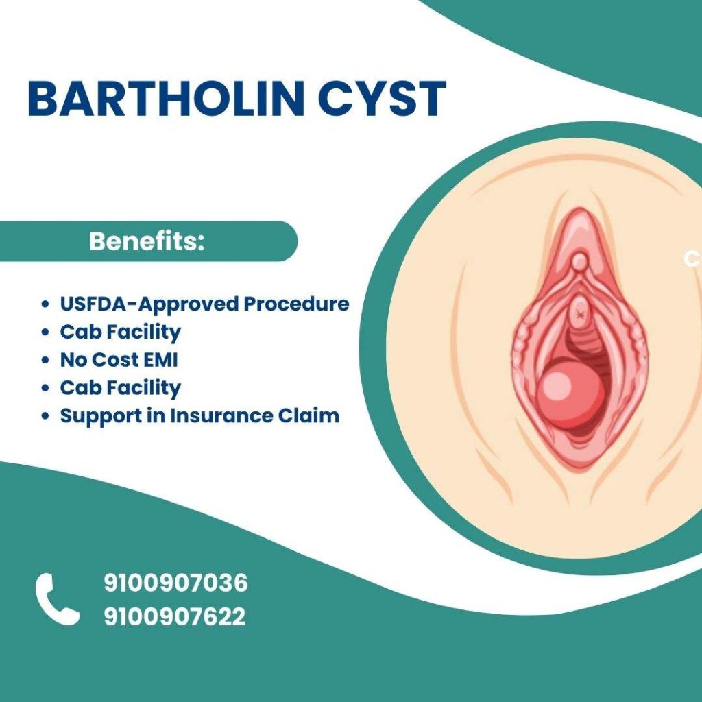 Bartholin cyst