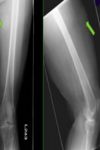 X-ray Both Thigh/Femur AP & LAT