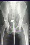 X-ray HSG