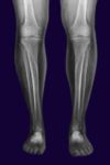 X-ray Both Lower Limbs