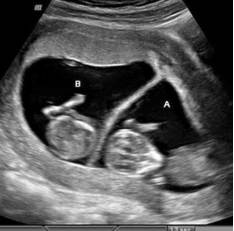 Ultrasound scan for Twins