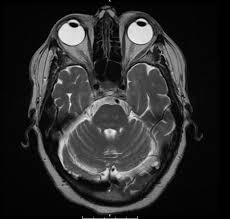 MRI-Face-And-Orbit