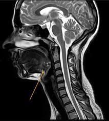 MRI-Thyroid