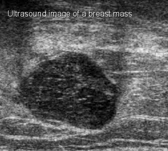 Breast Ultrasound Scan