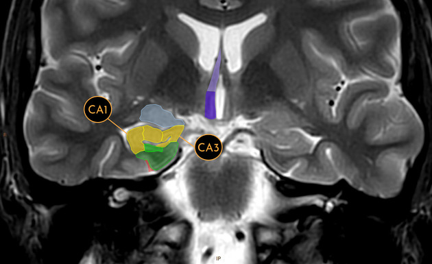 MRI Brain Epilepsy Protocol