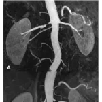 MR Angiography of Renal Artery