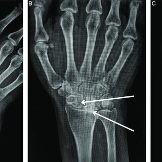 NCCT Right Wrist Joint