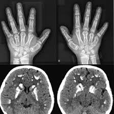 CECT Left Hand