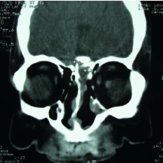 CECT-PNS-Sagittal