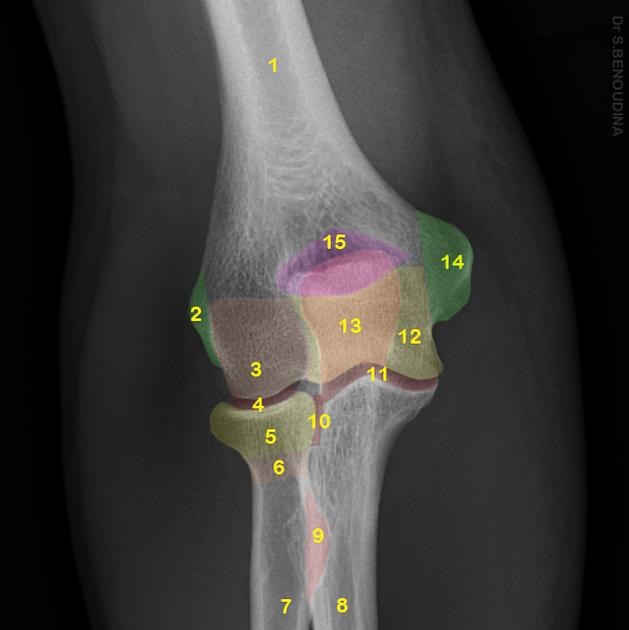 CECT Right Elbow Joint