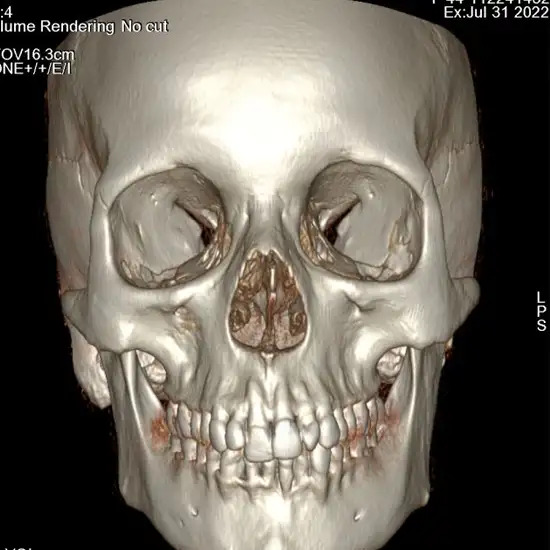 CT 3D Face Reconstruction