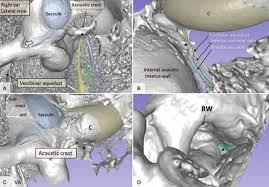 CT-3D-Reconstruction-Temporal-Bone