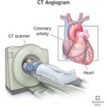 CT Angiography