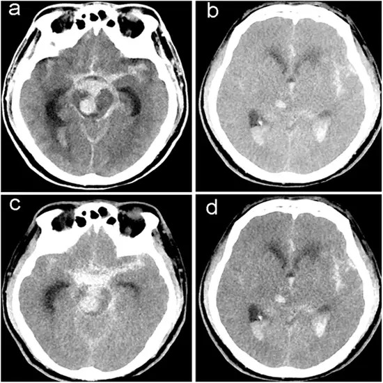CT Angiography Abdomen Dual Phase