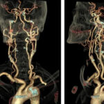 CT Carotid Angiography