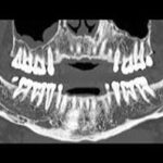 CT Dentascan
