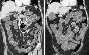 CT Enteroclysis