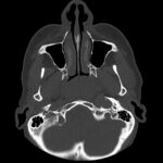 CT Facial Bone Scan