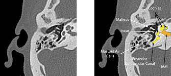 CT-Inner-Ear